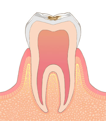 むし歯の進行段階C-1