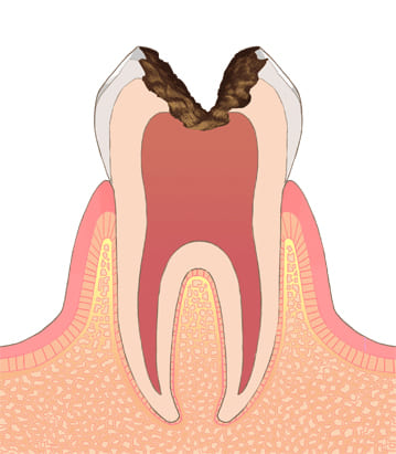 むし歯の進行段階C-3