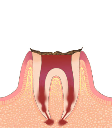 むし歯の進行段階C-4