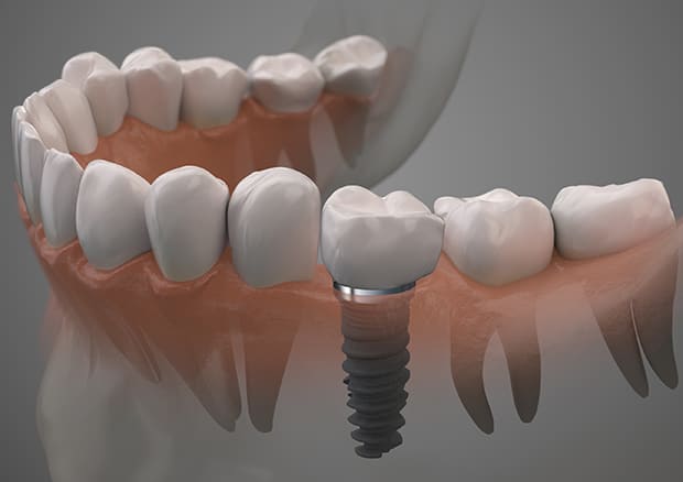 インプラント単独歯欠損のケース